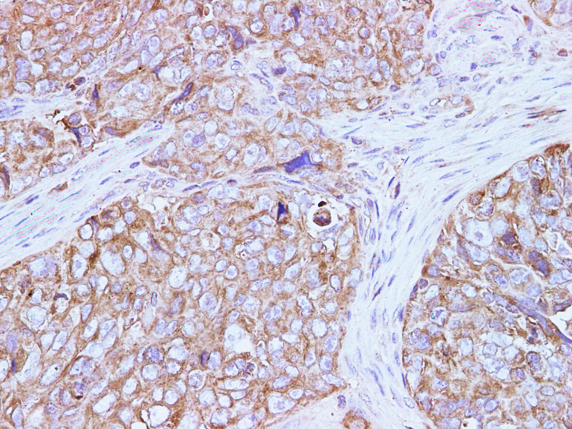 Immunohistochemistry of paraffin-embedded Human ovarian cancer  using AFP Polyclonal Antibody at dilution of 1:50