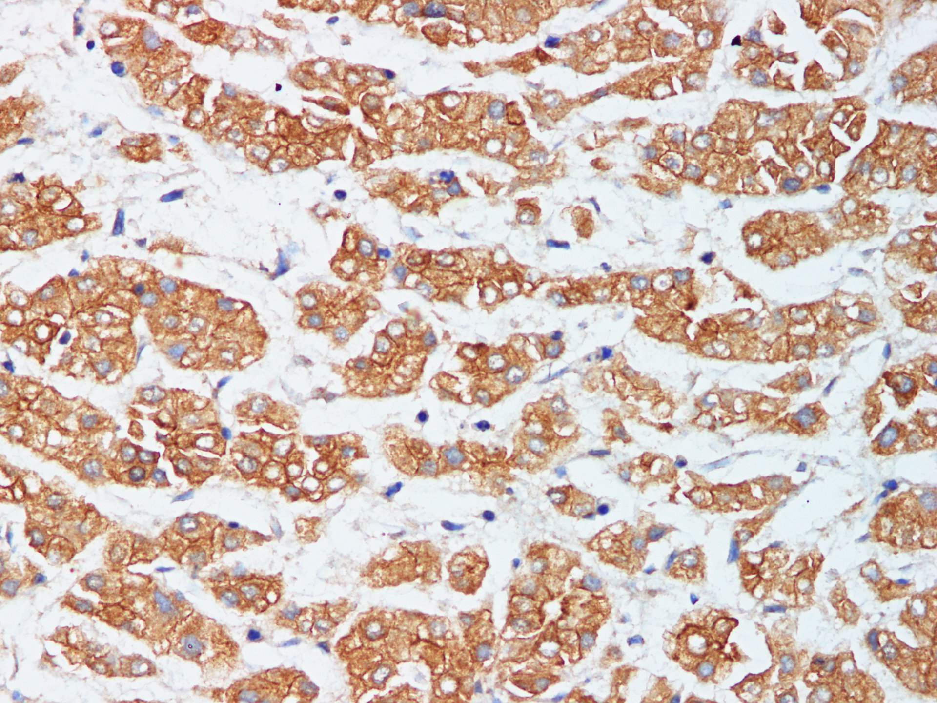 Immunohistochemistry of paraffin-embedded Human liver cancer using CK-18 Polyclonal Antibody at dilution of 1:200