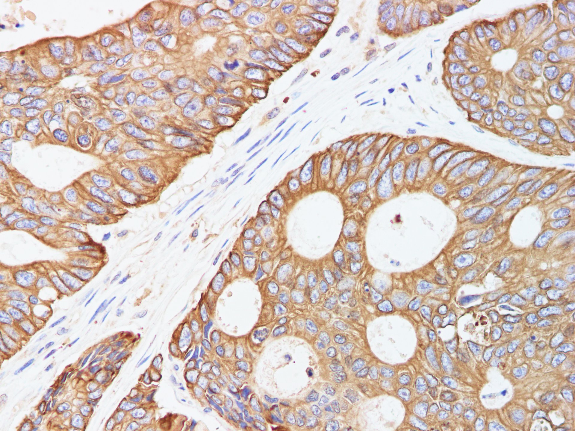 Immunohistochemistry of paraffin-embedded Human colorectal cancer using CK-18 Polyclonal Antibody at dilution of 1:200