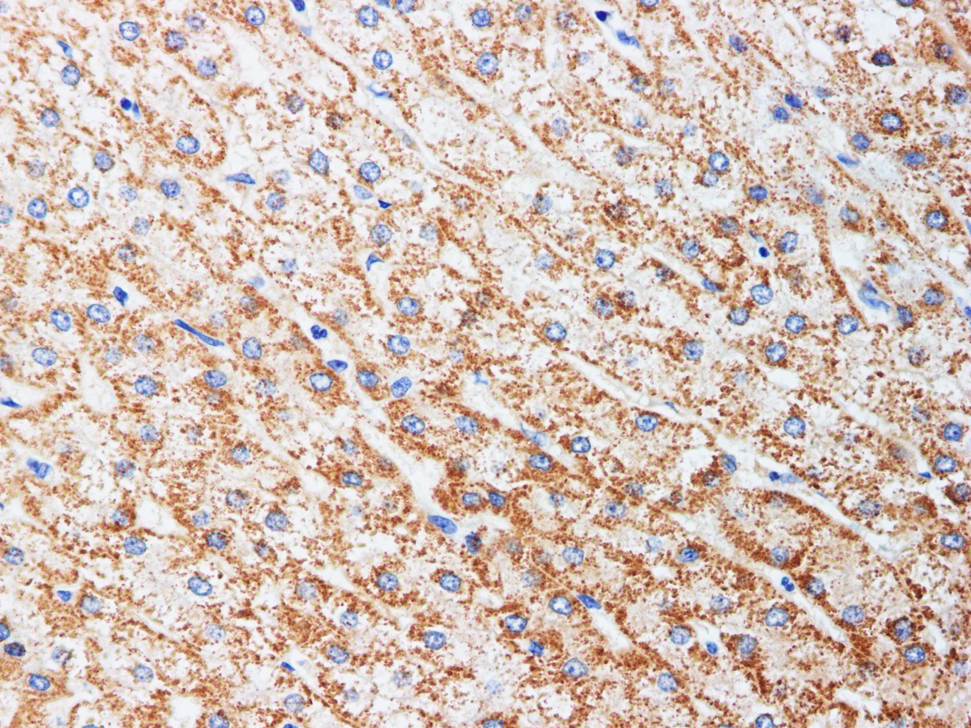 Immunohistochemistry of paraffin-embedded Human liver cancer using ADIPOQ Polyclonal Antibody at dilution of 1:200