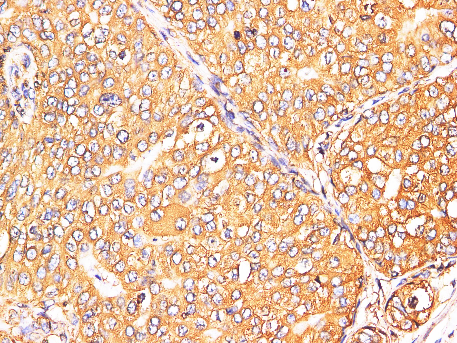 Immunohistochemistry of paraffin-embedded Human breast cancer using S100A9 Polyclonl Antibody at dilution of 1:200.