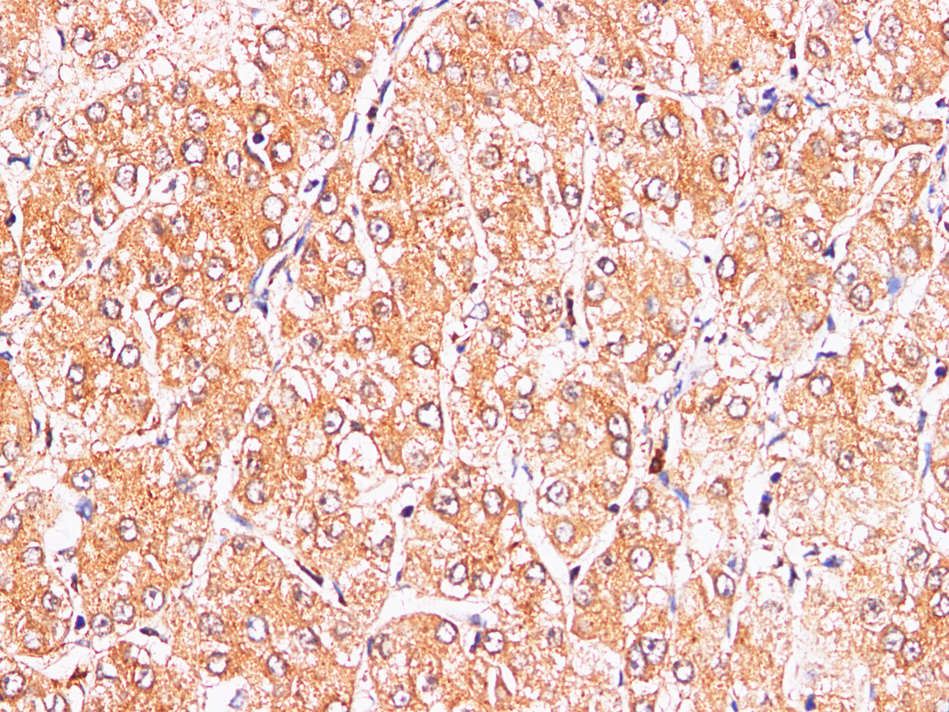 Immunohistochemistry of paraffin-embedded Human liver cancer using S100A9 Polyclonl Antibody at dilution of 1:200.