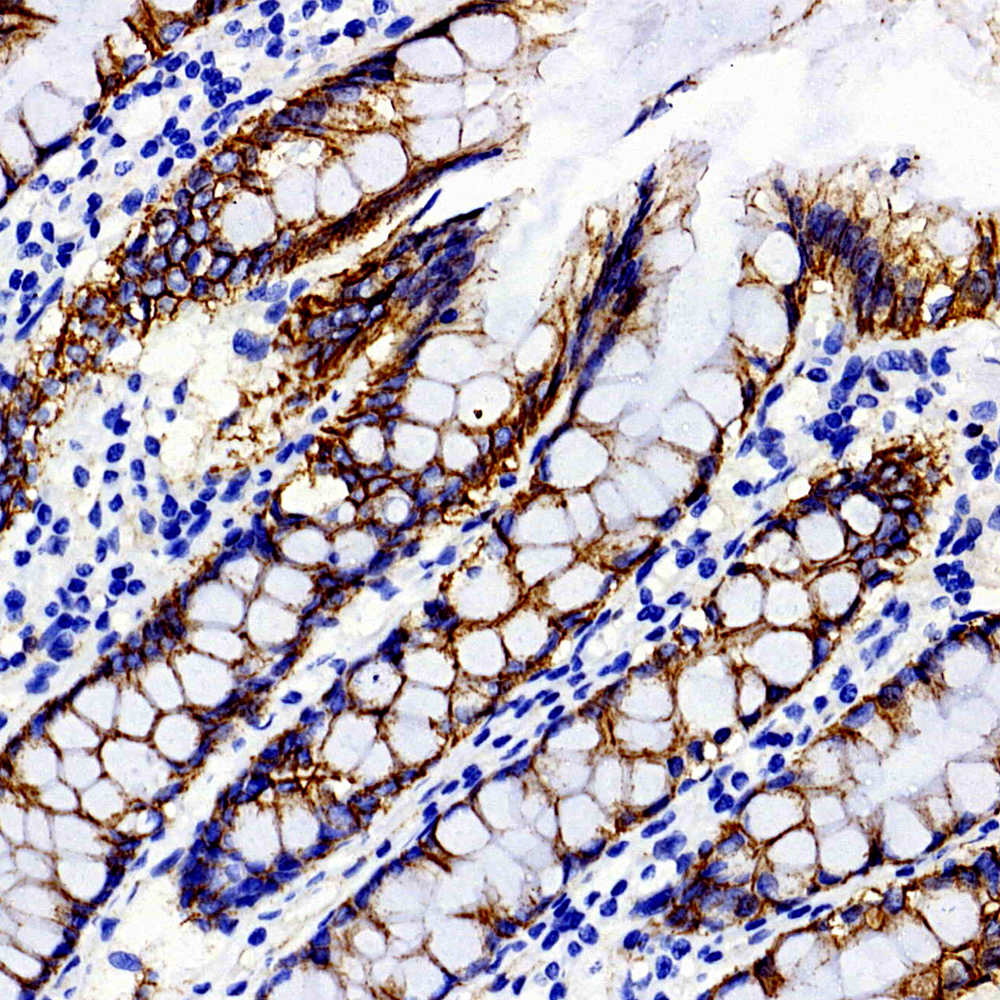 Immunohistochemistry analysis of paraffin-embedded Human colon tissue  using Catenin beta Polyclonal Antibody at dilution of 1:300.