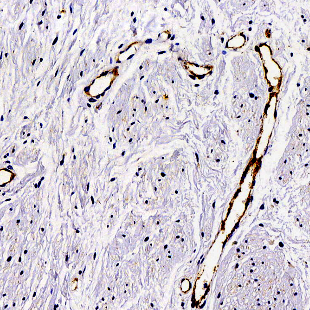Immunohistochemistry analysis of paraffin-embedded Human hysteromyoma  using VWF Polyclonal Antibody at dilution of 1:300.