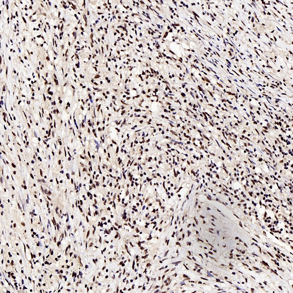 Immunohistochemistry analysis of paraffin-embedded human lung cancer  using c-Fos Polyclonal Antibody at dilution of 1:200.