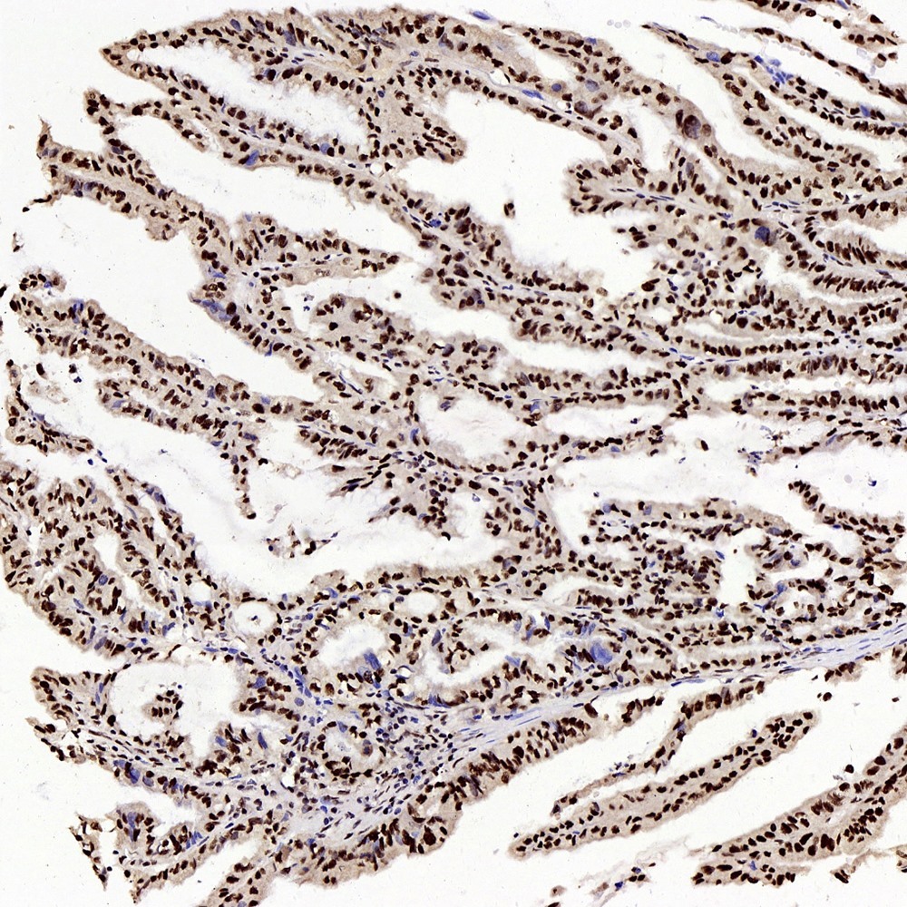 Immunohistochemistry analysis of paraffin-embedded human stomach cancer  using c-Fos Polyclonal Antibody at dilution of 1:200.