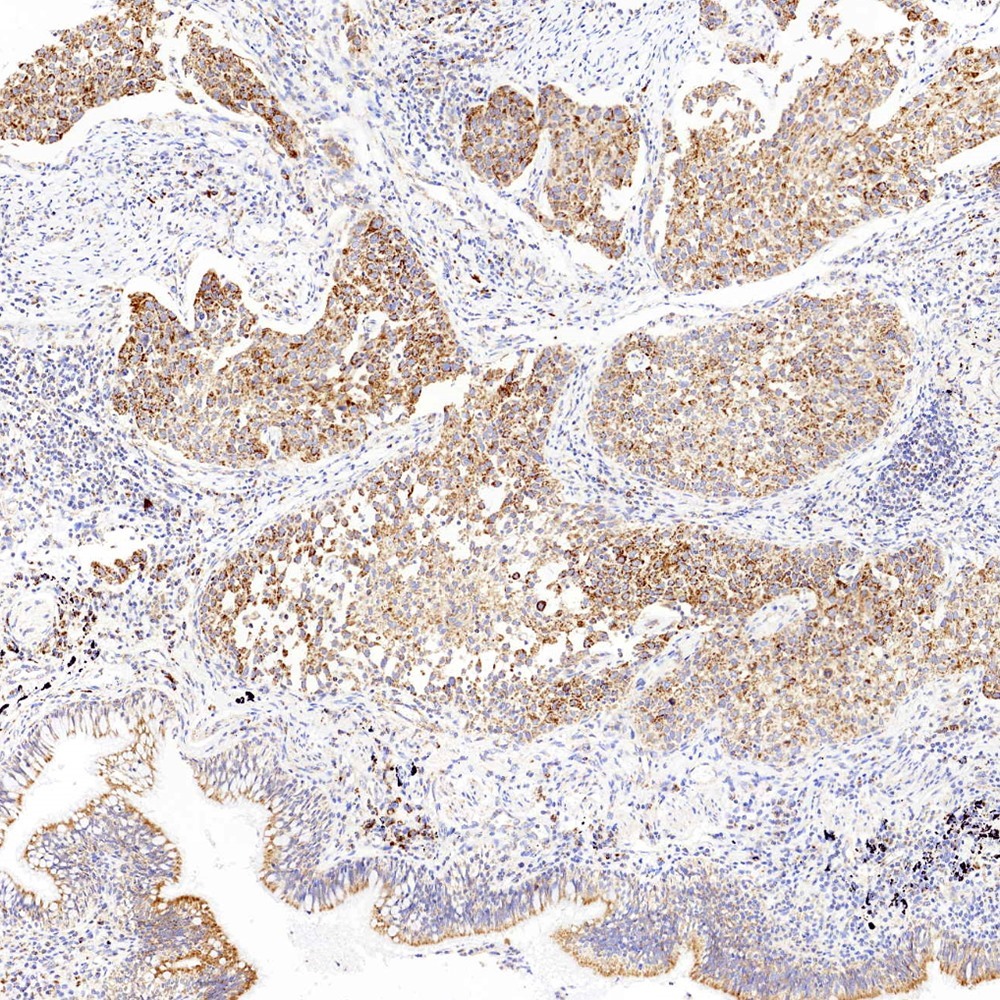 Immunohistochemistry analysis of paraffin-embedded human lung cancer  using CYCS Polyclonal Antibody at dilution of 1:1000.