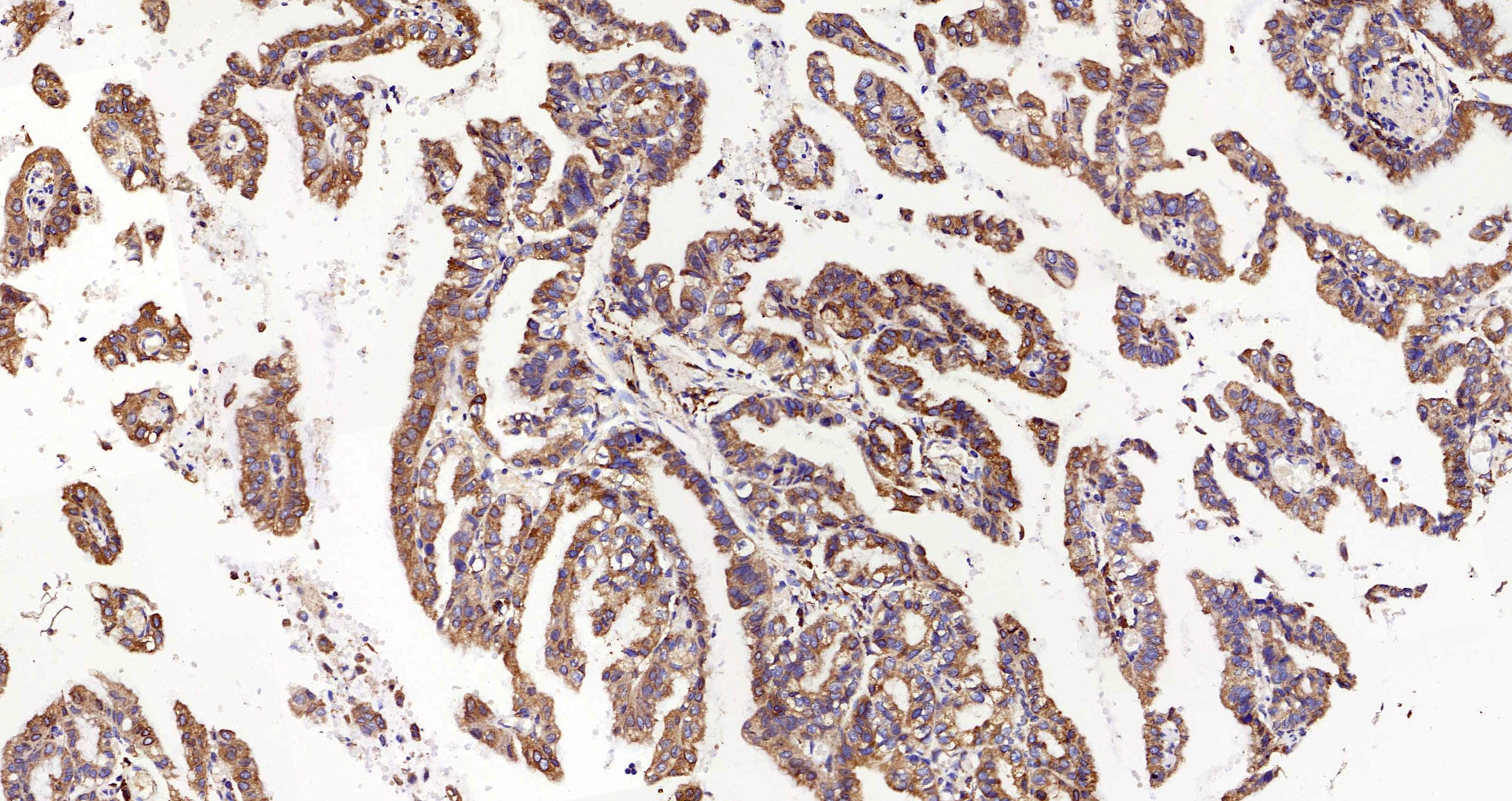 Immunohistochemistry analysis of paraffin-embedded human stomach cancer  using HSPA5 Polyclonal Antibody at dilution of 1:300.