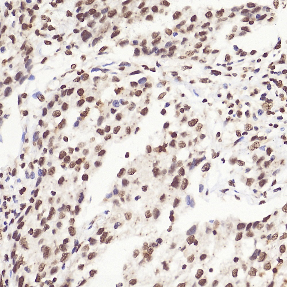 Immunohistochemistry analysis of paraffin-embedded Human liver cancer  using HMGB1 Polyclonal Antibody at dilution of 1:500.
