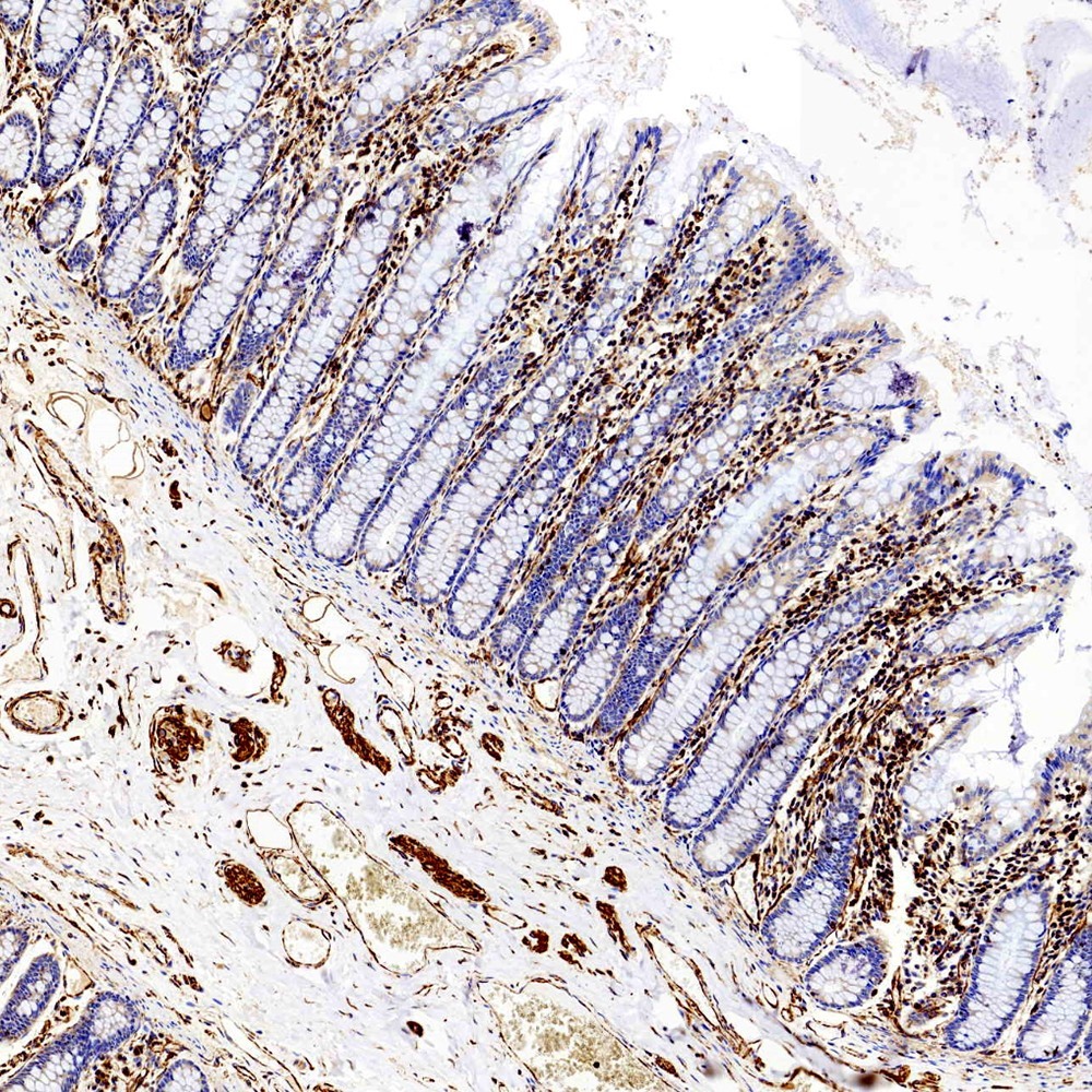 Immunohistochemistry analysis of paraffin-embedded Human colon  using Vimentin Polyclonal Antibody at dilution of 1:300.