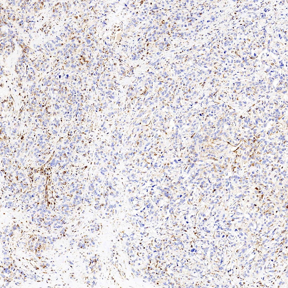 Immunohistochemistry analysis of paraffin-embedded Human liver cancer  using Vimentin Polyclonal Antibody at dilution of 1:300.