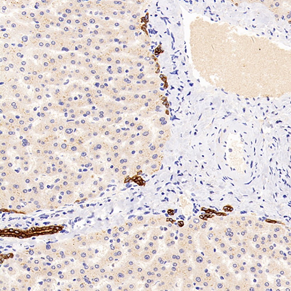 Immunohistochemistry analysis of paraffin-embedded human liver  using CK-19 Polyclonal Antibody at dilution of 1:300.