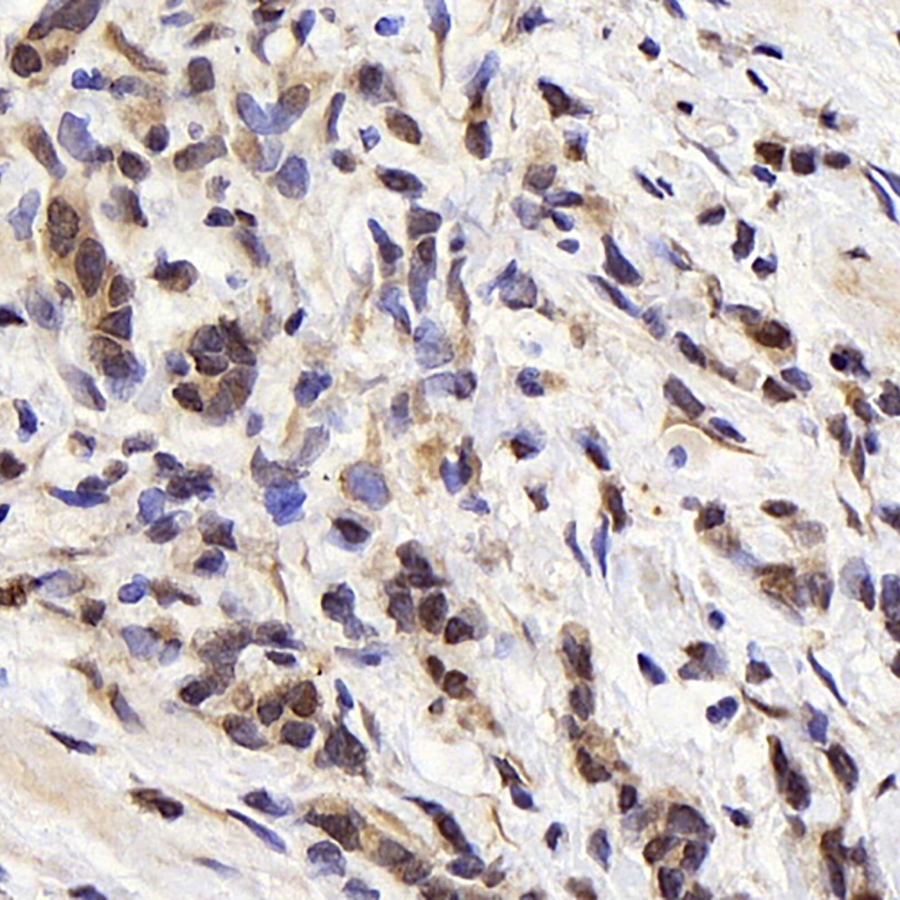 Immunohistochemistry analysis of paraffin-embedded human stomach cancer  using BAD Polyclonal Antibody at dilution of 1:300.