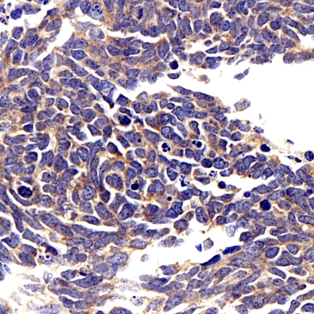 Immunohistochemistry analysis of paraffin-embedded human lung cancer  using CCL2 Polyclonal Antibody at dilution of 1:300.