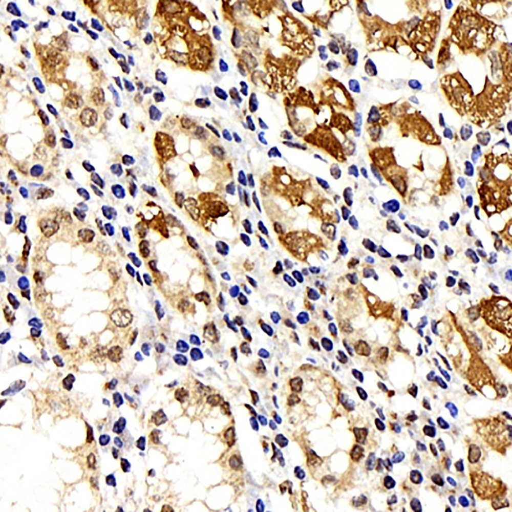 Immunohistochemistry analysis of paraffin-embedded human stomach cancer  using IkB alpha Polyclonal Antibody at dilution of 1:500.