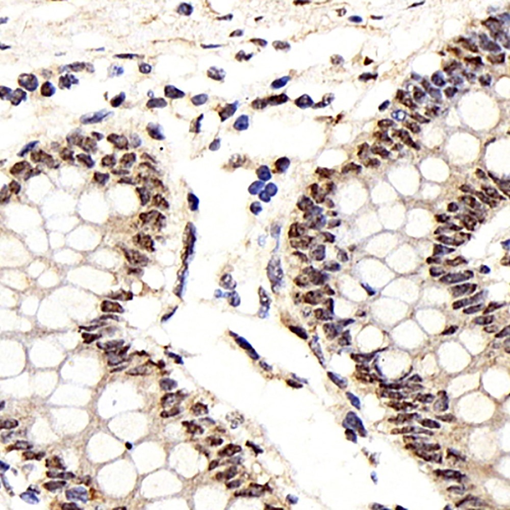 Immunohistochemistry analysis of paraffin-embedded human colon cancer  using IkB alpha Polyclonal Antibody at dilution of 1:500.