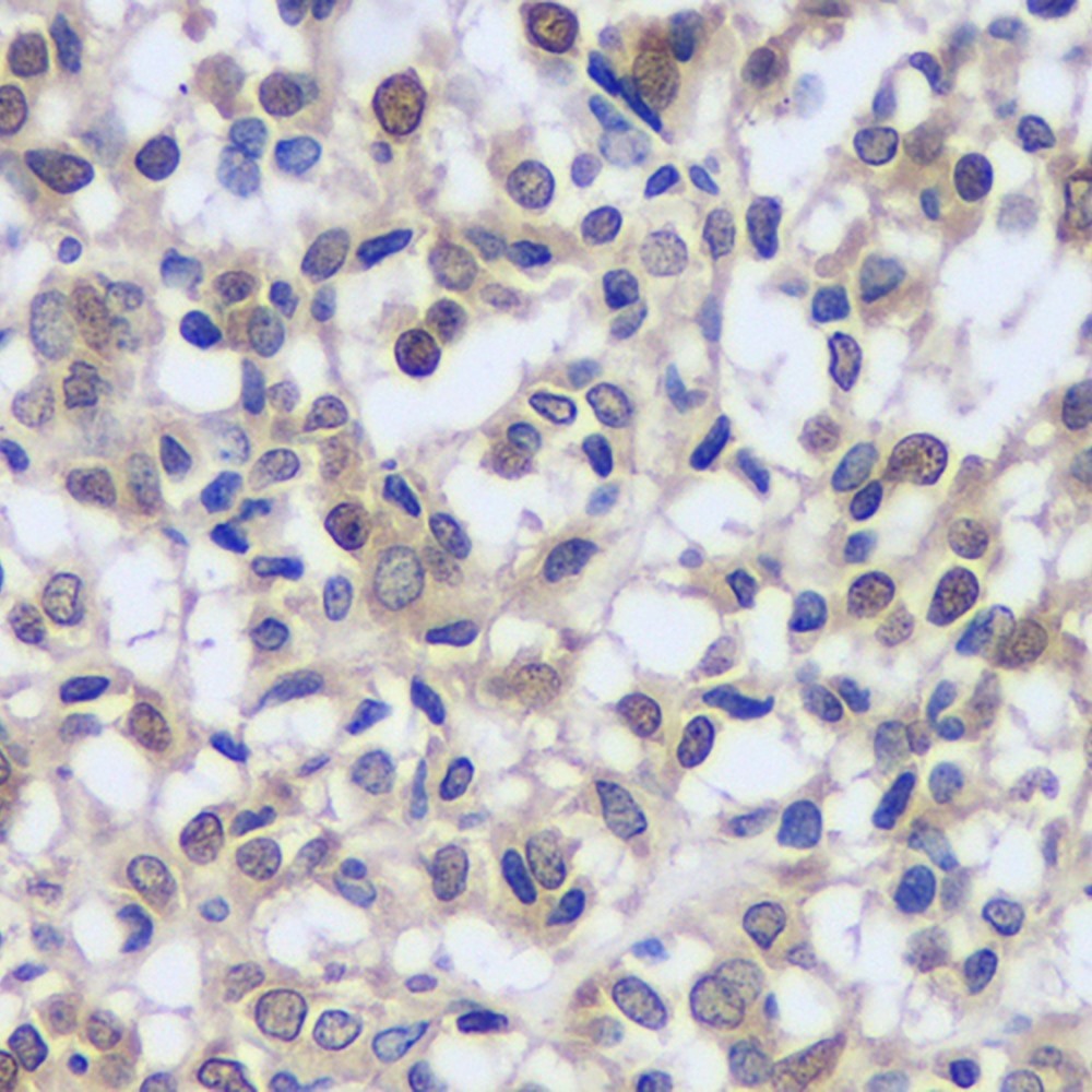 Immunohistochemistry analysis of paraffin-embedded human liver cancer   using CREB1 Polyclonal Antibody at dilution of 1:200.