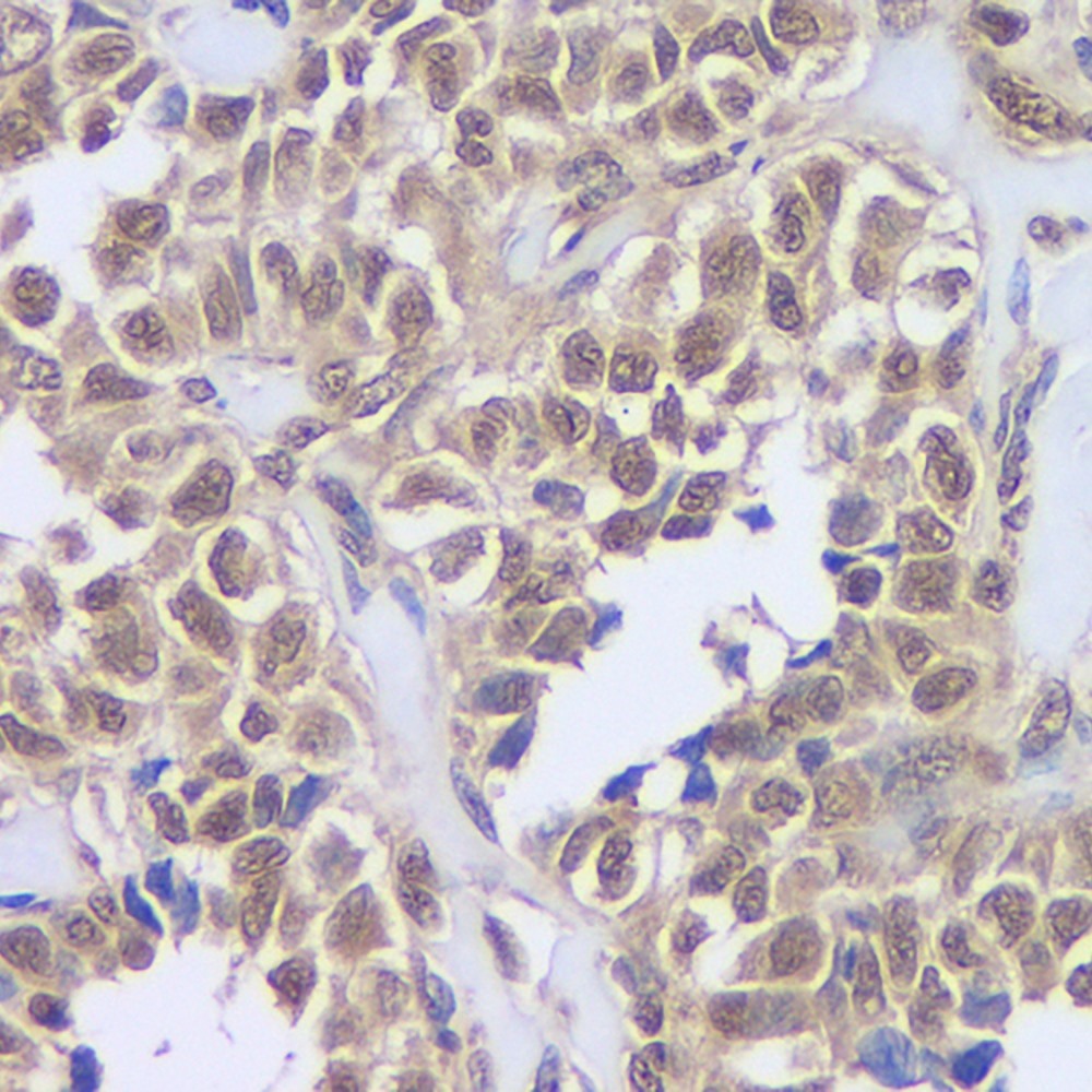 Immunohistochemistry analysis of paraffin-embedded human stomach cancer  using CREB1 Polyclonal Antibody at dilution of 1:200.