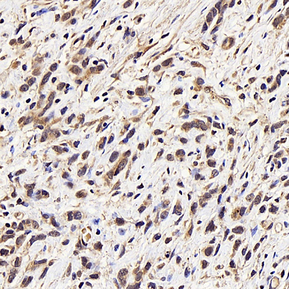 Immunohistochemistry analysis of paraffin-embedded human stomach cancer  using CDK4 Polyclonal Antibody at dilution of 1:100.