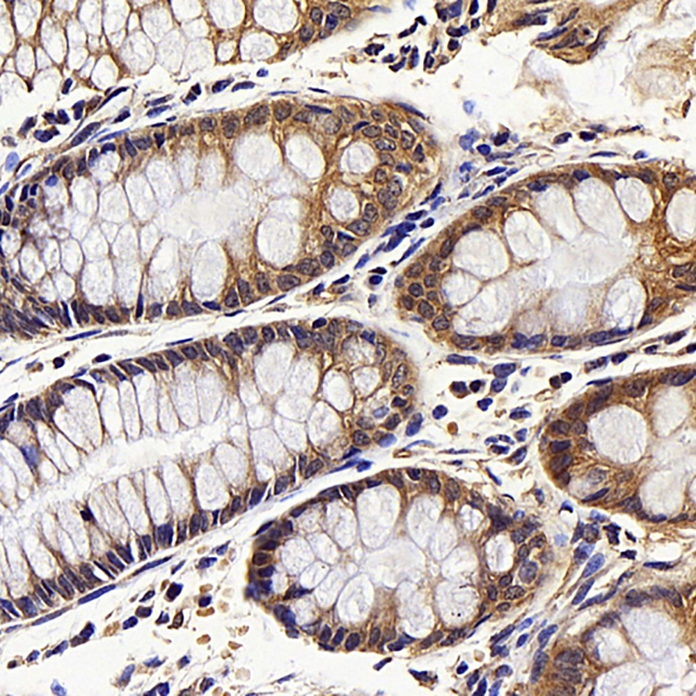 Immunohistochemistry analysis of paraffin-embedded human colon  using CDK4 Polyclonal Antibody at dilution of 1:100.