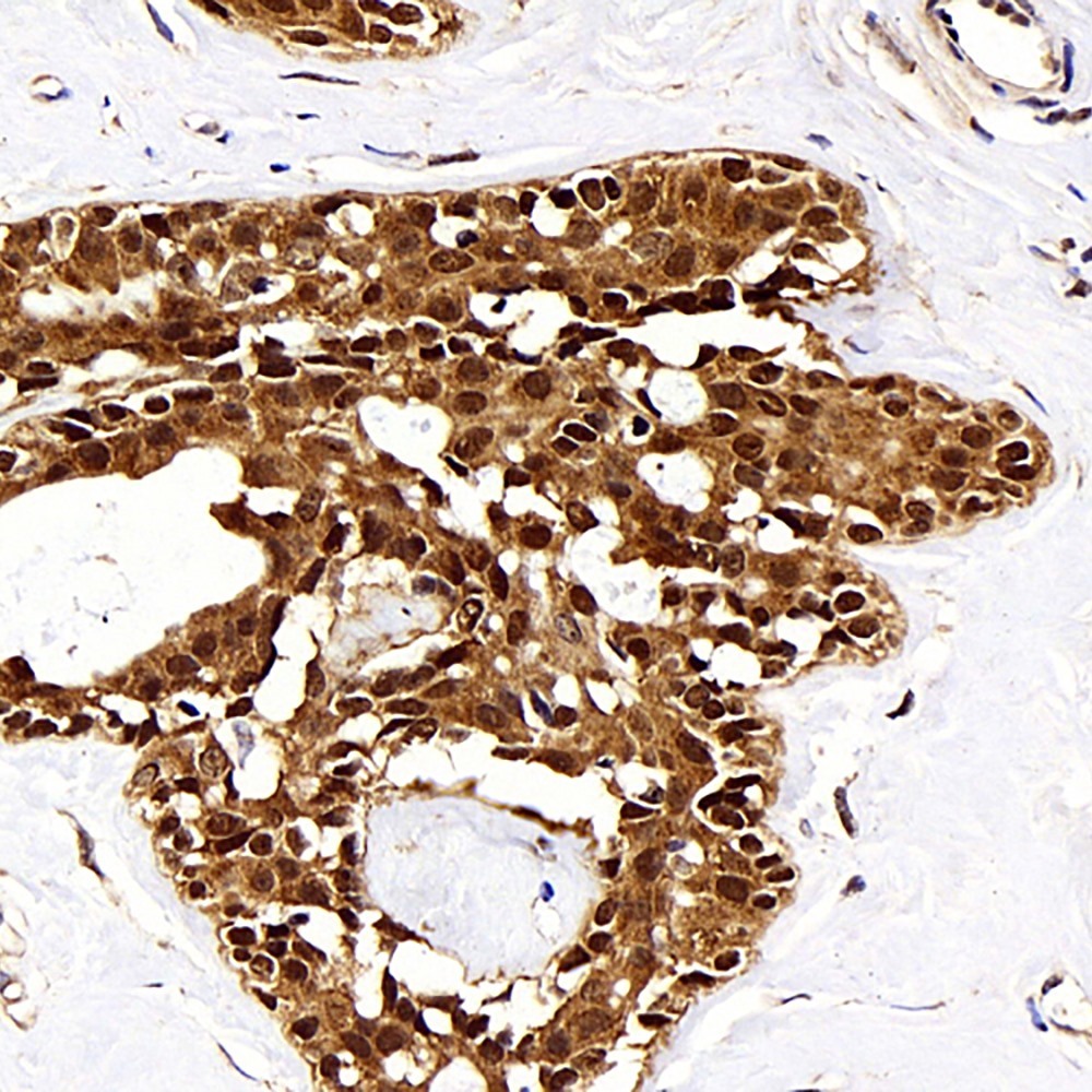 Immunohistochemistry analysis of paraffin-embedded human breast cancer  using HSPA1A Polyclonal Antibody at dilution of 1:500.