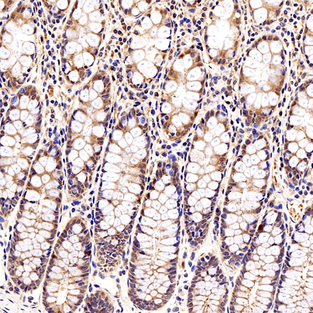 Immunohistochemistry analysis of paraffin-embedded human colon tissue  using Galectin 3 Polyclonal Antibody at dilution of 1:300.