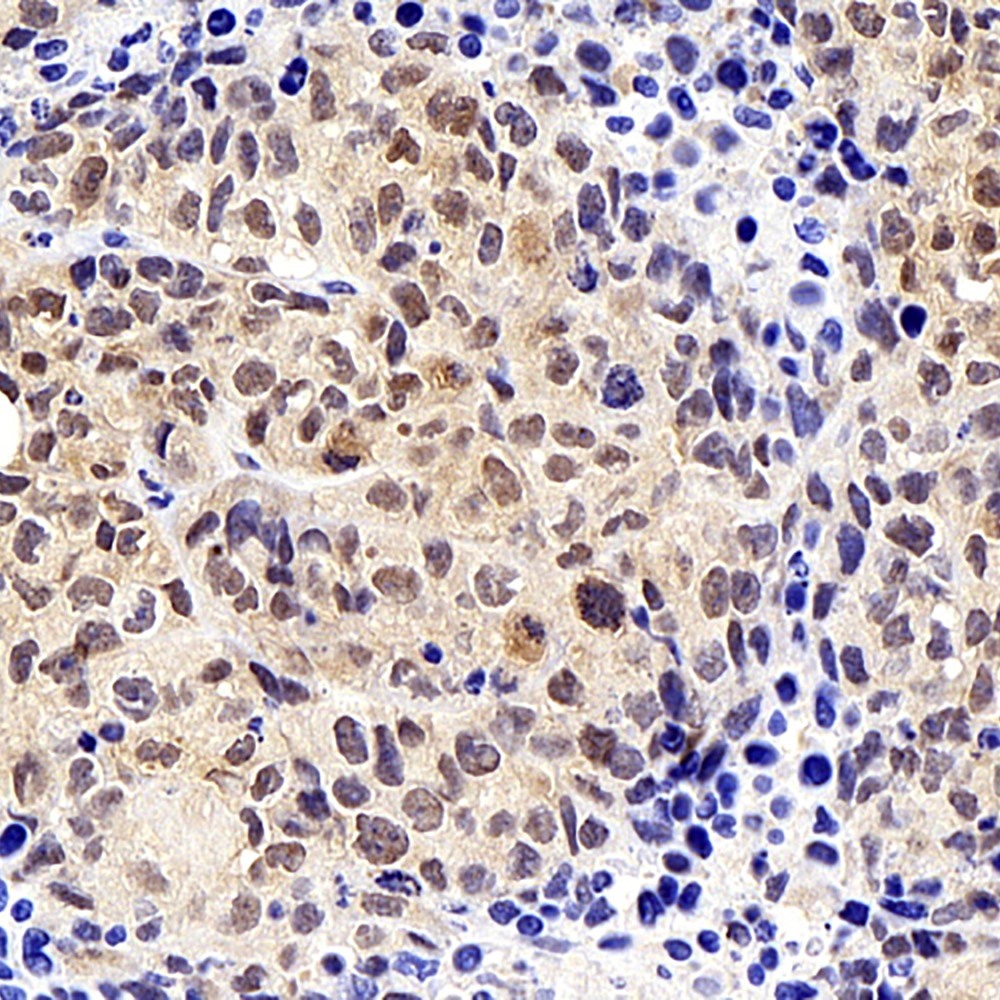 Immunohistochemistry analysis of paraffin-embedded mice tumor with hela  using SOX-2 Polyclonal Antibody at dilution of 1:300.