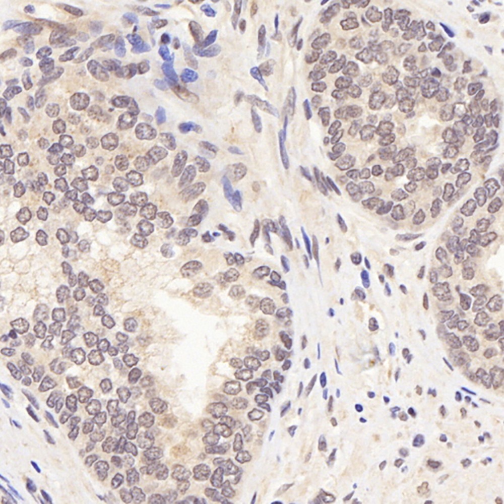 Immunohistochemistry analysis of paraffin-embedded human Prostate  using AR Polyclonal Antibody at dilution of 1:300.