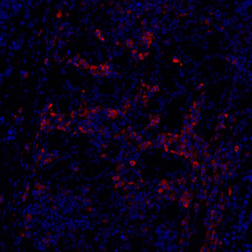 Immunofluorescence analysis of paraffin-embedded Human lung cancer  using Cyclin B1 Polyclonal Antibody at dilution of 1:100.