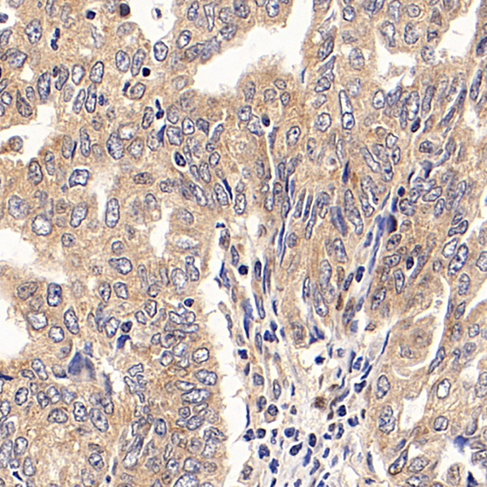 Immunohistochemistry analysis of paraffin-embedded human endometrial cancer  using PGR Polyclonal Antibody at dilution of 1:300.