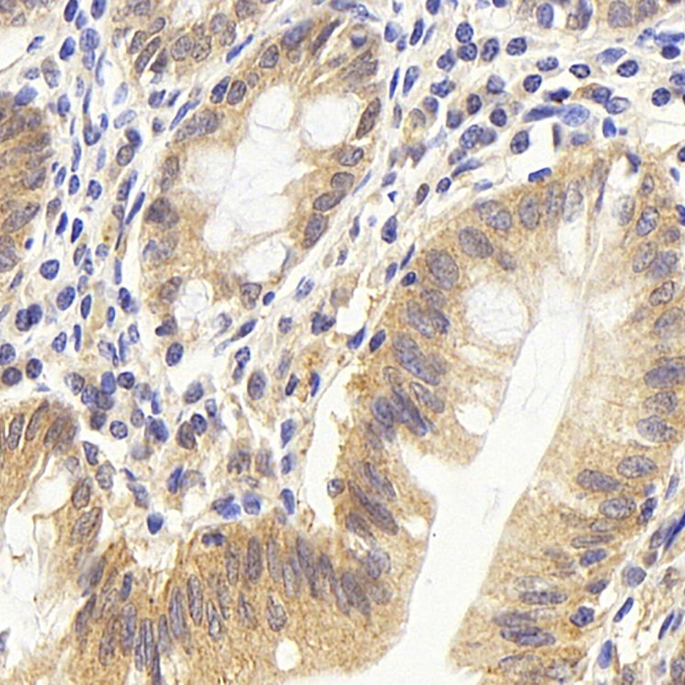 Immunohistochemistry analysis of paraffin-embedded human colon  using CDC25A Polyclonal Antibody at dilution of 1:1000.