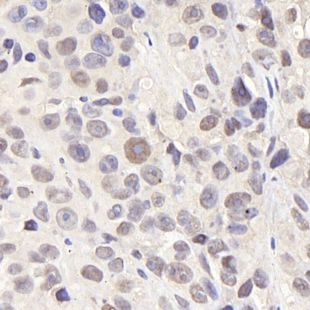 Immunohistochemistry analysis of paraffin-embedded Mouse breast cancer  using CDC25A Polyclonal Antibody at dilution of 1:1000.