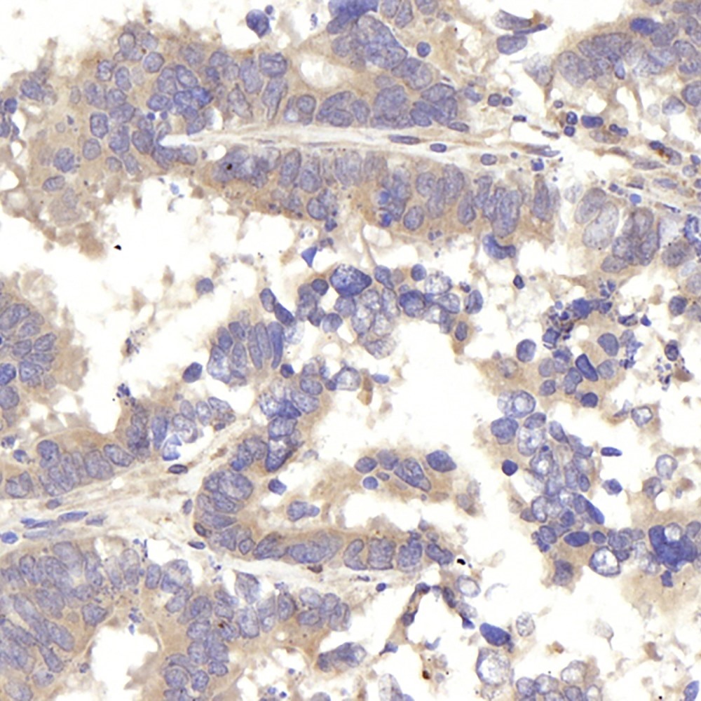 Immunohistochemistry analysis of paraffin-embedded human colon cancer  using IKK alpha Polyclonal Antibody at dilution of 1:300.