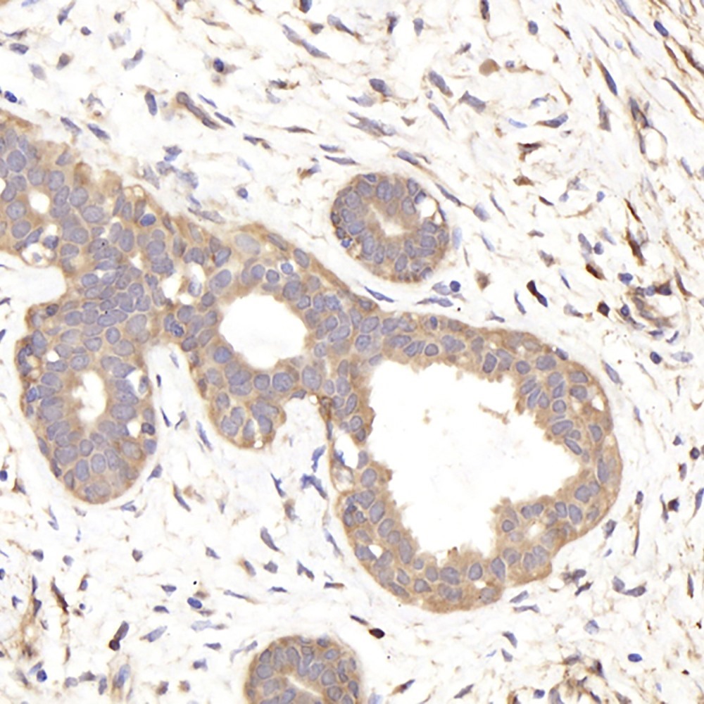 Immunohistochemistry analysis of paraffin-embedded human breast cancer  using IKK alpha Polyclonal Antibody at dilution of 1:300.