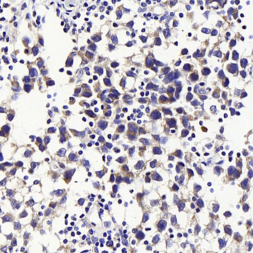 Immunohistochemistry analysis of paraffin-embedded human testis cancer  using GLUT-3 Polyclonal Antibody at dilution of 1:300.