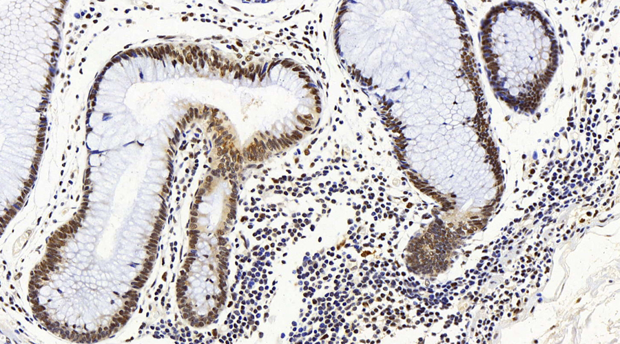 Immunohistochemistry analysis of paraffin-embedded human colon  using MAP2K1 Polyclonal Antibody at dilution of 1:100.