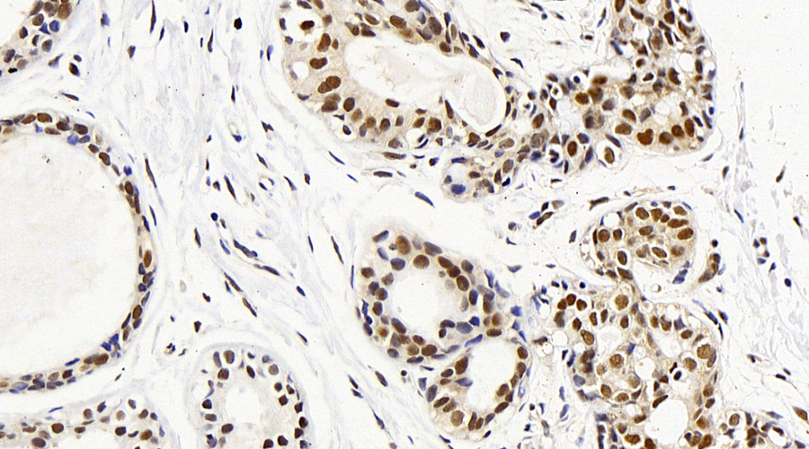 Immunohistochemistry analysis of paraffin-embedded human breast cancer  using MAP2K1 Polyclonal Antibody at dilution of 1:100.