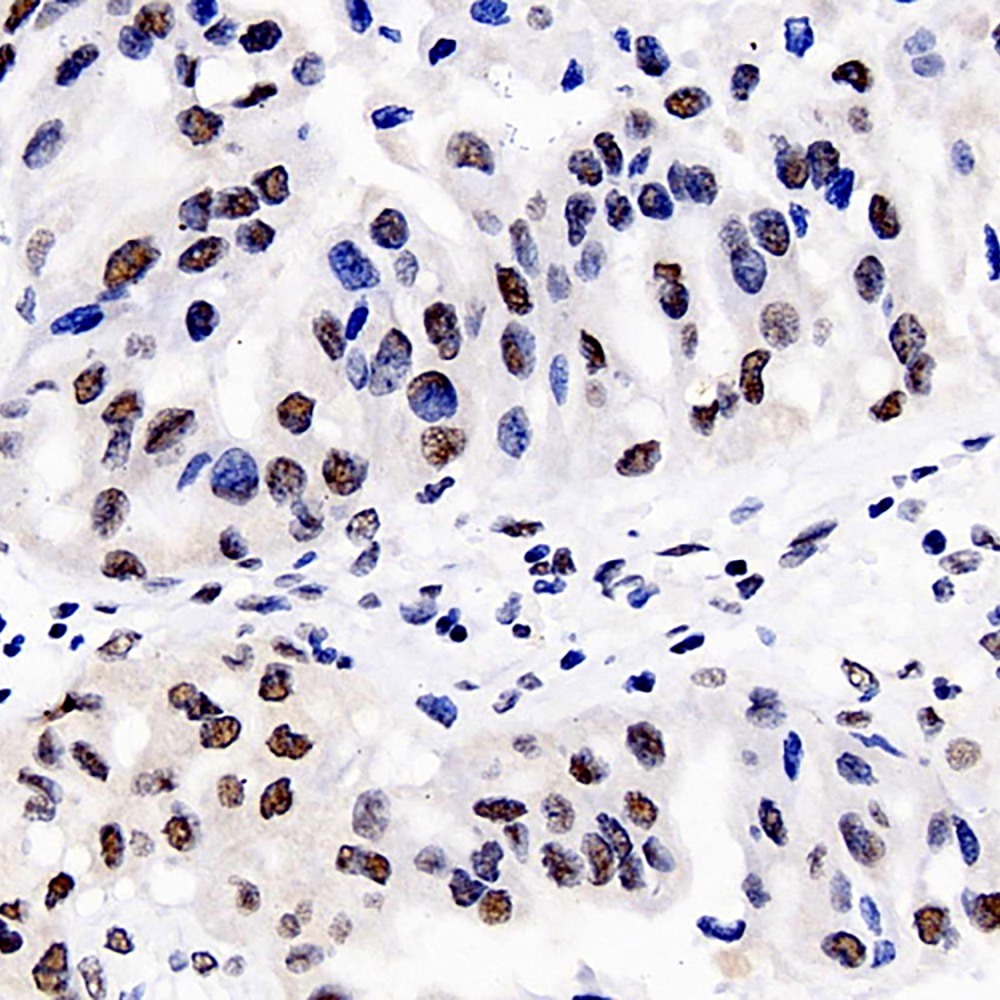 Immunohistochemistry analysis of paraffin-embedded human liver cancer   using DNMT1 Polyclonal Antibody at dilution of 1:300.