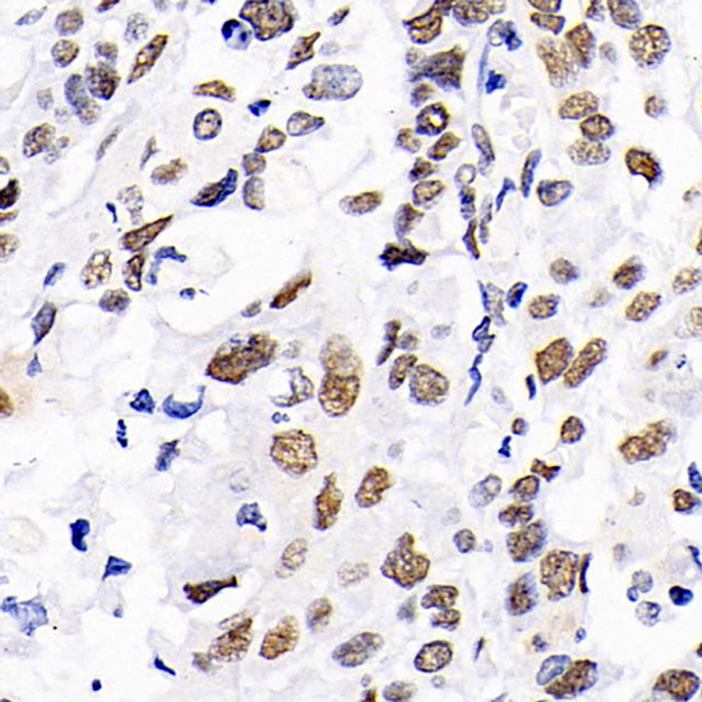 Immunohistochemistry analysis of paraffin-embedded human lung cancer   using DNMT1 Polyclonal Antibody at dilution of 1:300.