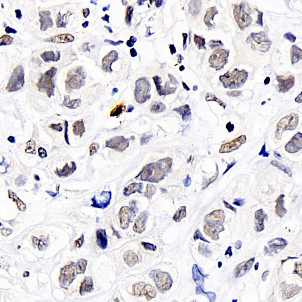 Immunohistochemistry analysis of paraffin-embedded human breast cancer  using DNMT1 Polyclonal Antibody at dilution of 1:300.