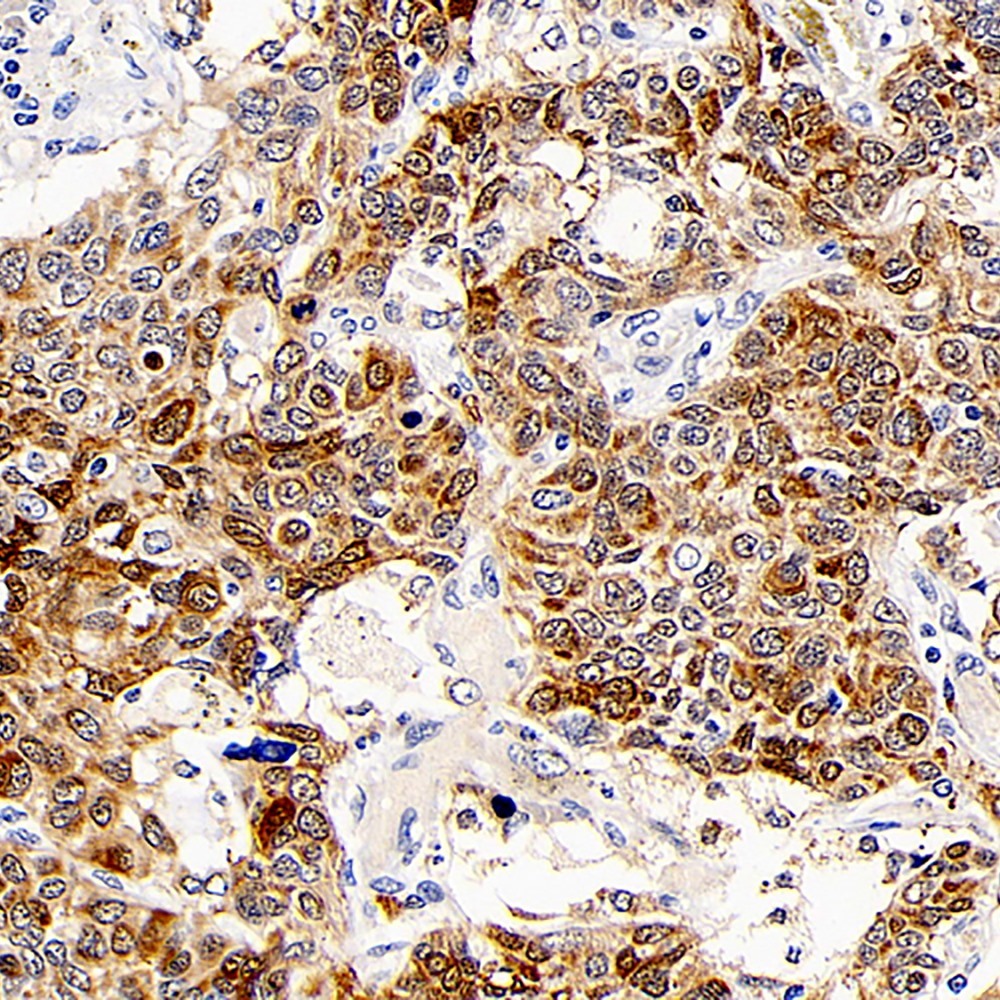 Immunohistochemistry analysis of paraffin-embedded human lung cancer  using CD107b Polyclonal Antibody at dilution of 1:300.