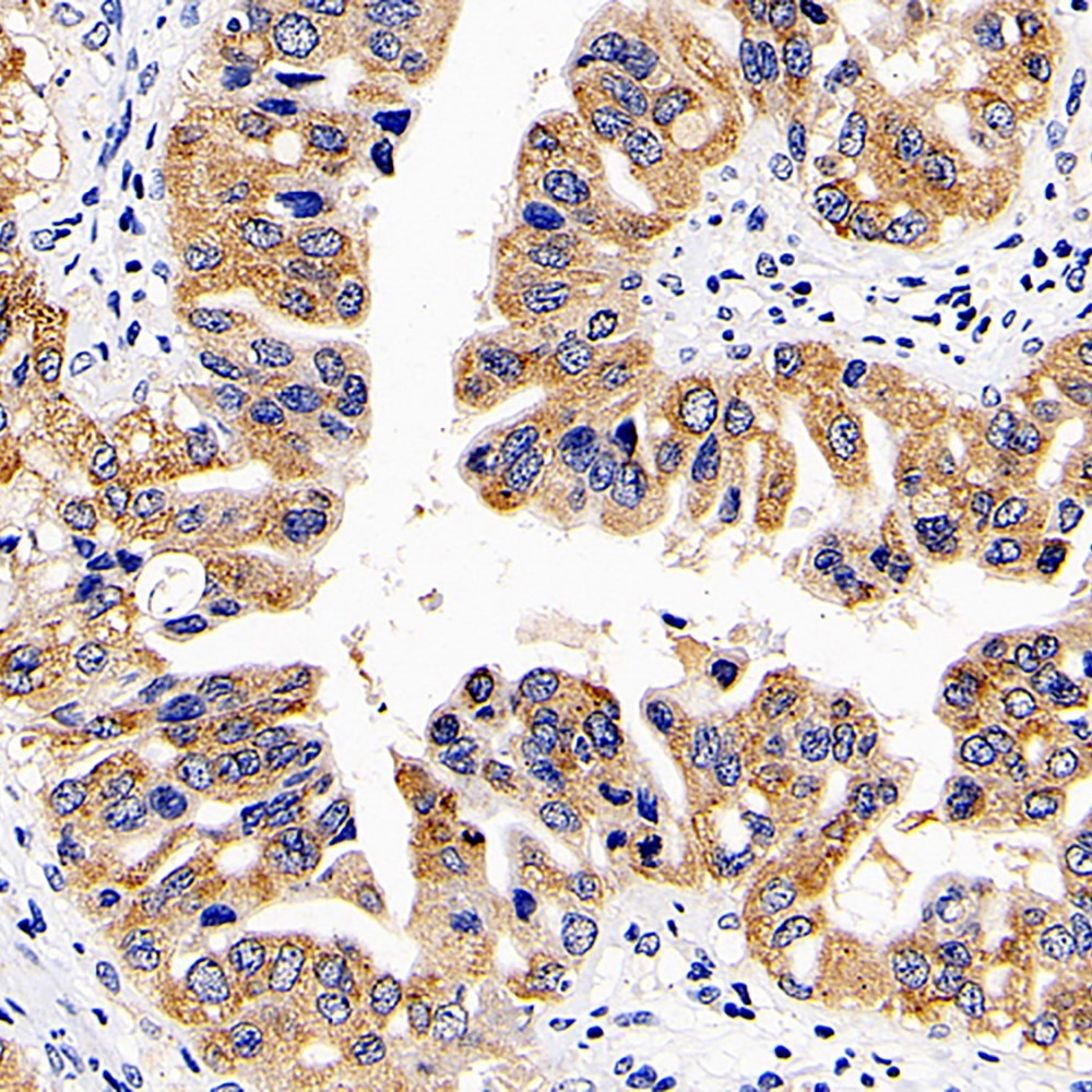 Immunohistochemistry analysis of paraffin-embedded human liver cancer  using CD107b Polyclonal Antibody at dilution of 1:300.