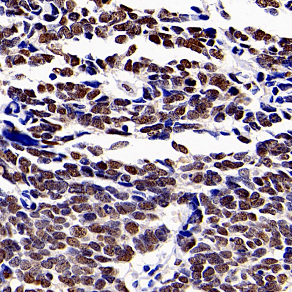 Immunohistochemistry analysis of paraffin-embedded human lung cancer   using HDAC1 Polyclonal Antibody at dilution of 1:300.