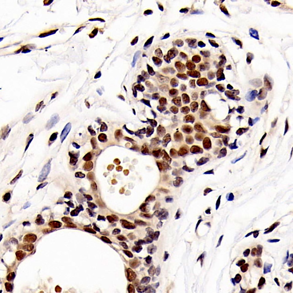 Immunohistochemistry analysis of paraffin-embedded human breast cancer   using HDAC1 Polyclonal Antibody at dilution of 1:300.