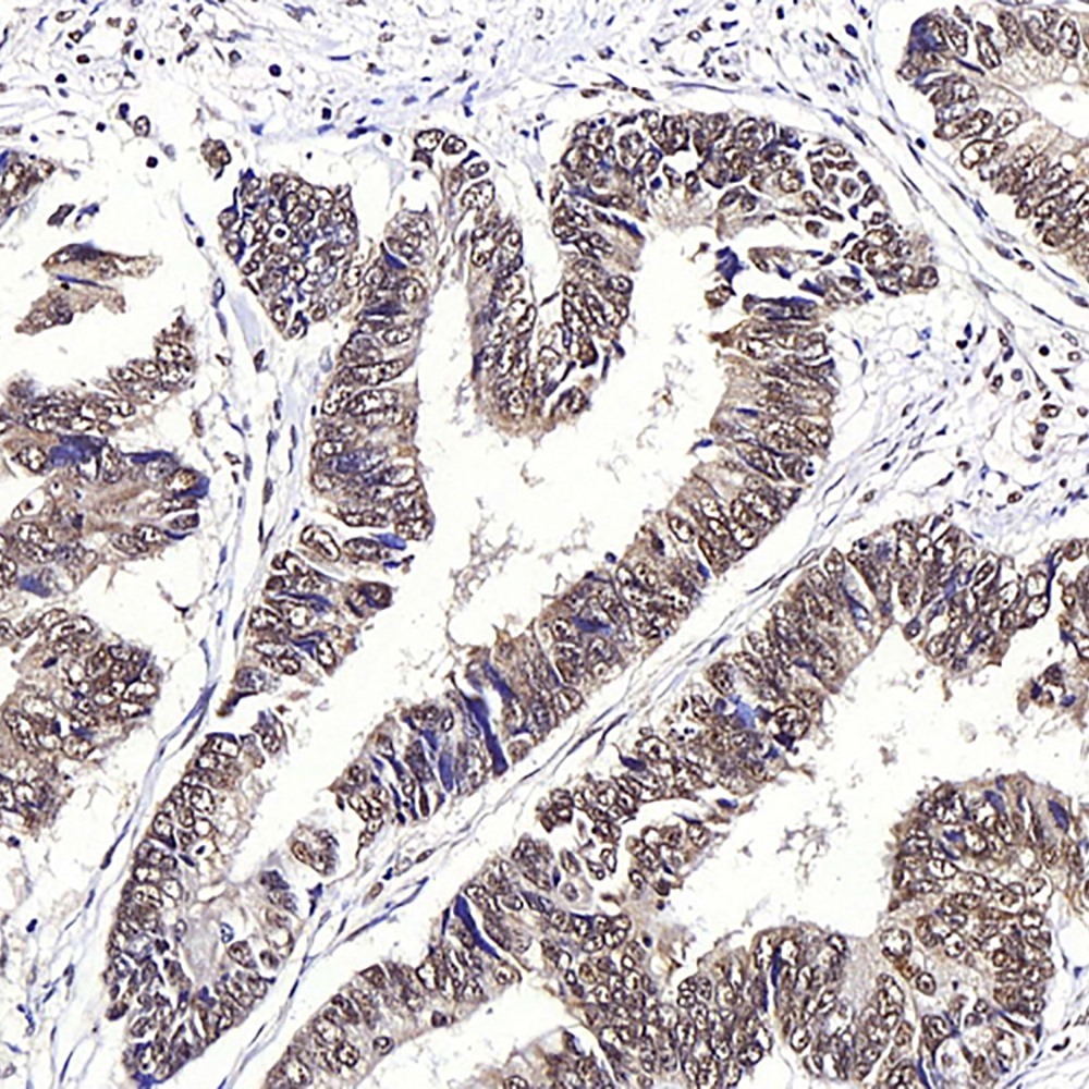Immunohistochemistry analysis of paraffin-embedded human colon cancer  using JMJD6 Polyclonal Antibody at dilution of 1:1000.