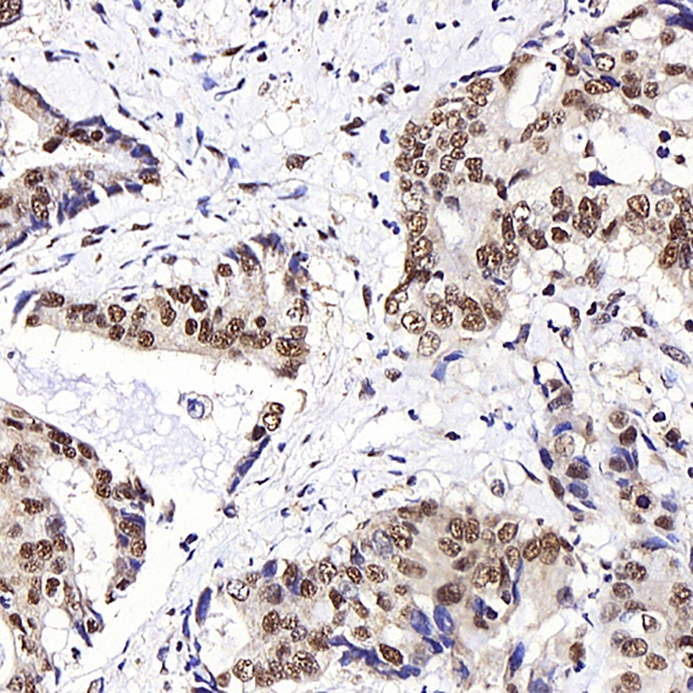 mmunohistochemistry analysis of paraffin-embedded human stomach cancer  using JMJD6 Polyclonal Antibody at dilution of 1:1000.