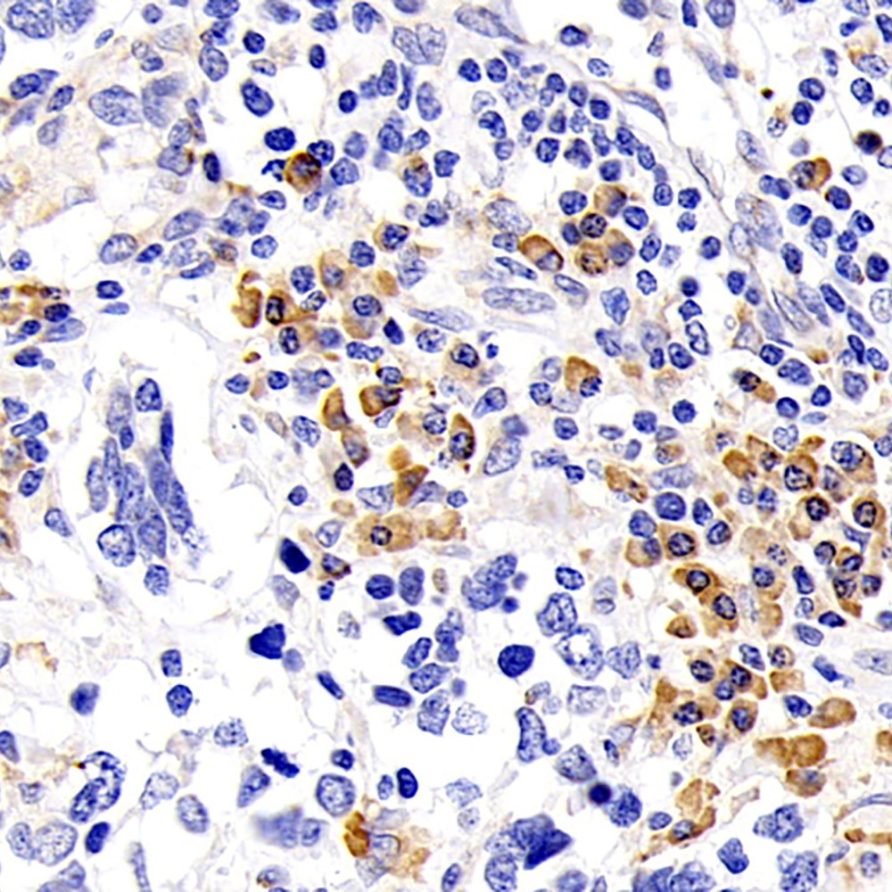 Immunohistochemistry analysis of paraffin-embedded human lung cancer  using SIRT7 Polyclonal Antibody at dilution of 1:200.