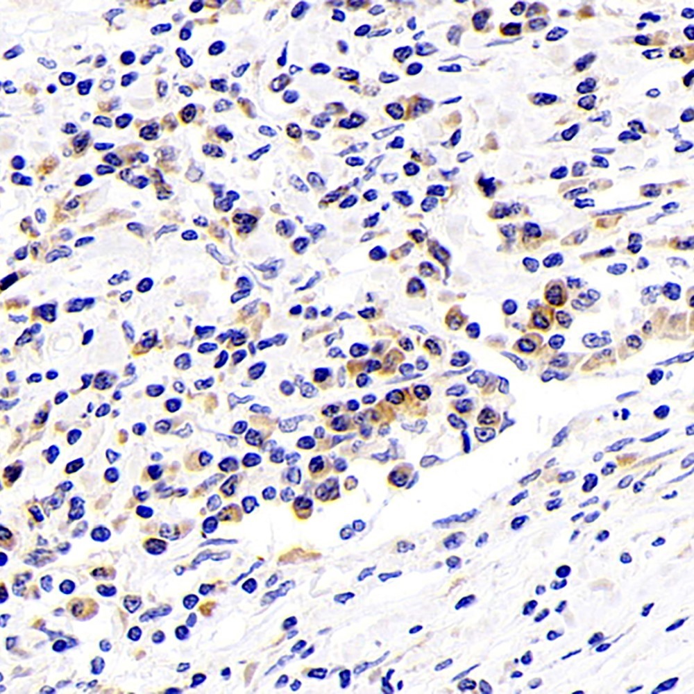 Immunohistochemistry analysis of paraffin-embedded human stomach cancer  using SIRT7 Polyclonal Antibody at dilution of 1:200.