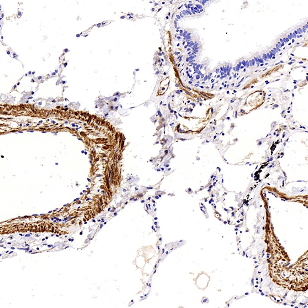 Immunohistochemistry analysis of paraffin-embedded human lung cancer  using TAGLN Polyclonal Antibody at dilution of 1:400.