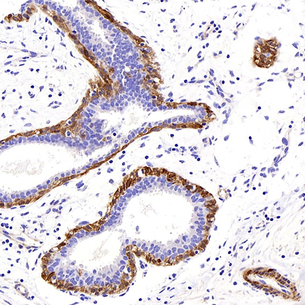 Immunohistochemistry analysis of paraffin-embedded human breast cancer  using TAGLN Polyclonal Antibody at dilution of 1:400.